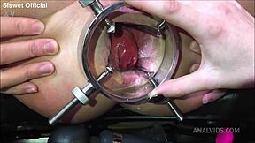 They Fist Wreck Asshole Bulging Belly in Extreme Lesbian Anal Session